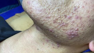Best Pimple Popping P1 | Mụn Dậy Thì Siêu Hấp Dẫn P1 - SacDepSpa#181 screenshot 3